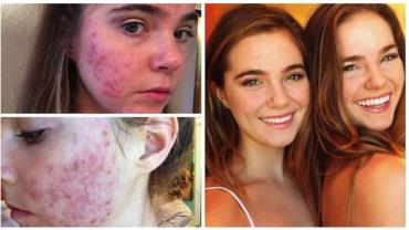 Gêmeas conseguem se livrar de problema com acne em apenas três dias