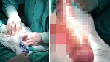 Homem passa por cirurgia após usar mandioca de 45cm como brinquedo sexual
