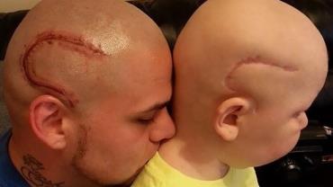 Pai tatua cicatriz em apoio a filho que enfrenta tumor no cérebro