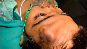 Médicos implantam "nariz" na testa de menino que perdeu órgão na infância