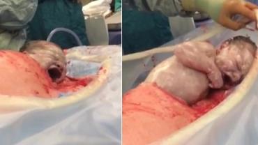 Bebê "rasteja" para sair do útero da mãe durante cesariana e vídeo viraliza
