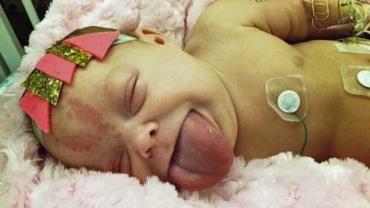 Bebê com rara doença da "língua gigante" opera e sorri pela 1ª vez