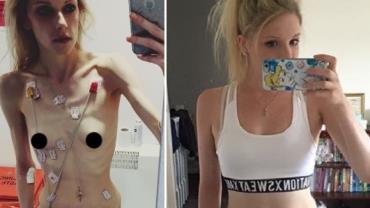 Jovem que chegou a pesar 35 kg desabafa e faz apelo: "Anorexia destrói vidas"