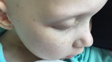 Pai registra último fio dos cílios de menina que enfrenta câncer