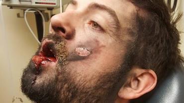 Homem perde dentes e sofre queimaduras em explosão de cigarro eletrônico