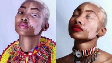 Após sofrer com bullying, modelo sul-africana luta para mudar concepção sobre beleza