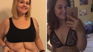Após perder 76 kg, mulher faz cirurgia e remove excesso de pele