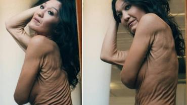 Mulher de 26 anos desafia padrões de beleza com "pele rara"