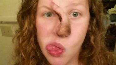 Mulher compartilha fotos chocantes de câncer que deformou seu rosto
