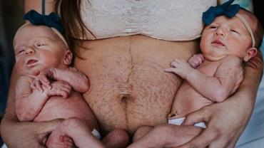 Mãe mostra marcas na barriga após dar à luz gêmeas: "sinal dos milagres do meu corpo"