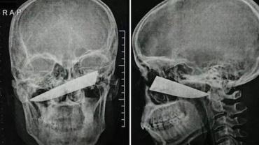 Homem fica com faca cravada na cabeça ao tentar parar briga entre amigos