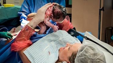 Mãe retira bebê do útero durante cesárea emocionante: "Foi maravilhoso"