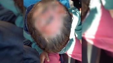 Menino de 4 anos acusa pai e madrasta de queimarem sua cabeça com ferro de passar