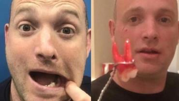 Sem atendimento odontológico por causa do coronavírus, homem arranca o próprio dente