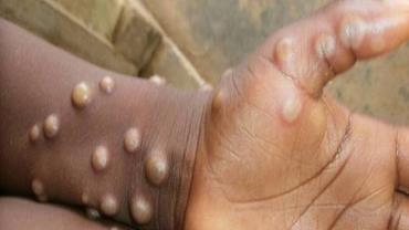 OMS diz esperar que mais casos de varíola dos macacos surjam pelo mundo