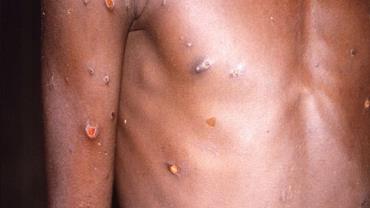 Exame descarta caso de varíola dos macacos em Macaé, no Rio de Janeiro