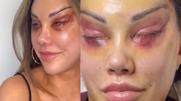 Influencer fica deformada após cirurgia para ter "olhos de gata"