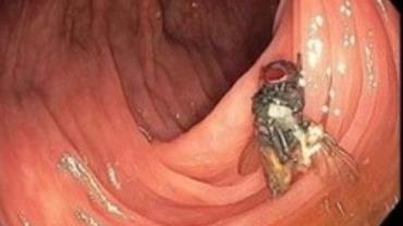Mosca viva é encontrada em intestino de paciente durante exame