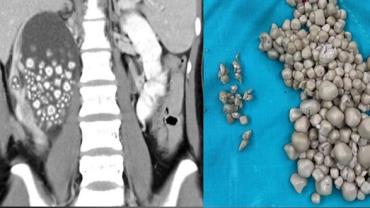 Jovem de 20 anos passa por cirurgia para retirada de 300 pedras no rim