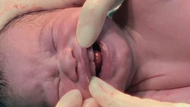 Bebê nasce com dentes e surpreende médicos: "pequeno milagre"