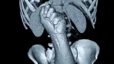 Viralizou: Raio-x mostra braço de 38cm de comprimento preso no reto de um homem