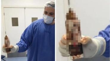 Homem dá entrada no hospital com desodorante de 14 cm introduzido no reto