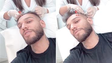 Lucas Lucco faz tratamento contra calvície: "Melhor levar agulhada que ficar careca"