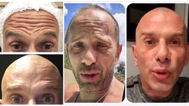 Rafael Ilha mostra antes e depois de botox e harmonização facial: "Estou surpreso"