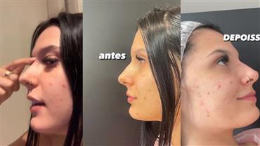 Ana Castela realiza procedimento estético no nariz